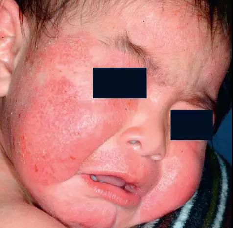 面部湿疹是怎么引起的图片