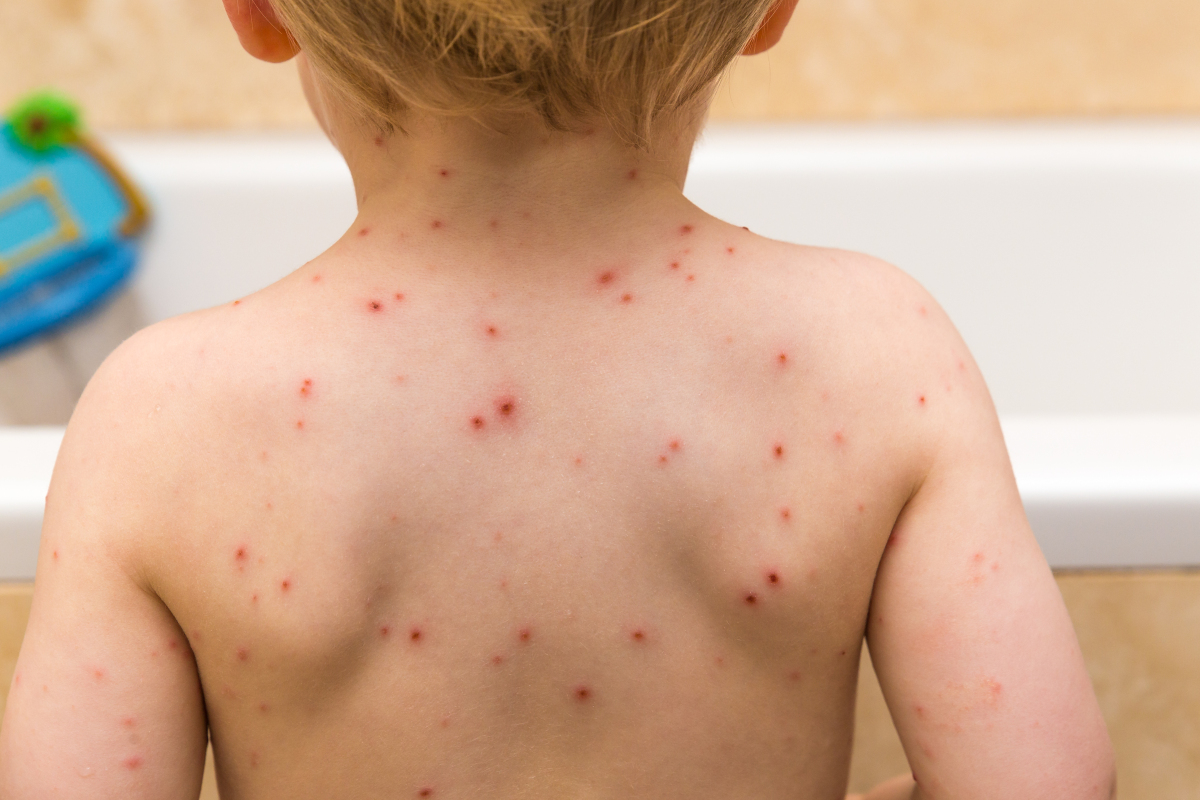 急性荨麻疹的症状 出现这7种症状 - 学堂在线健康网