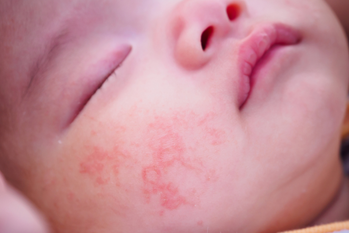 婴儿湿疹的诊断治疗研究进展 - 爱爱医医学网